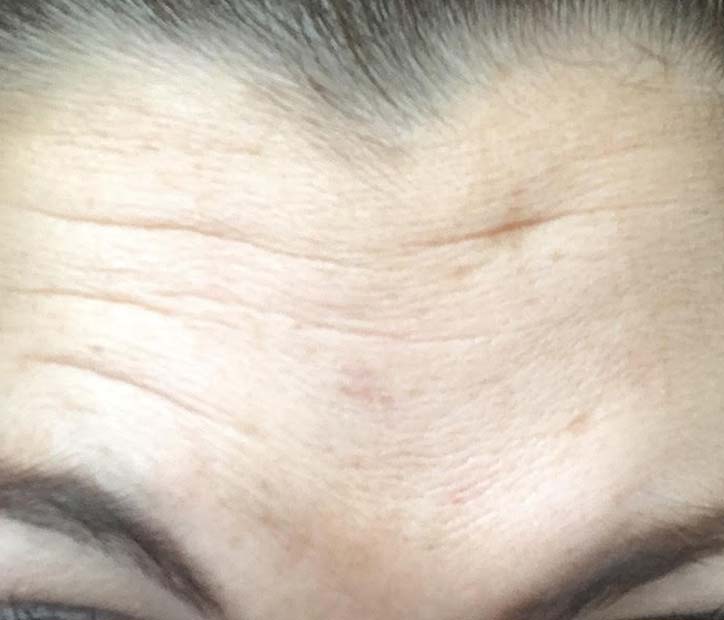 Botox – during