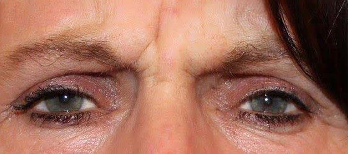 Botox – before