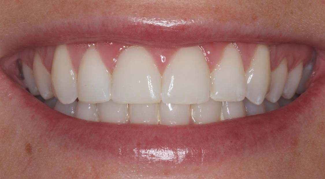 Braces then whitening – after