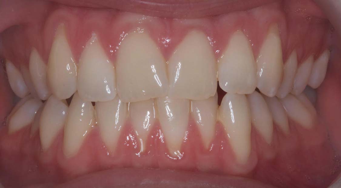 Braces then whitening – before