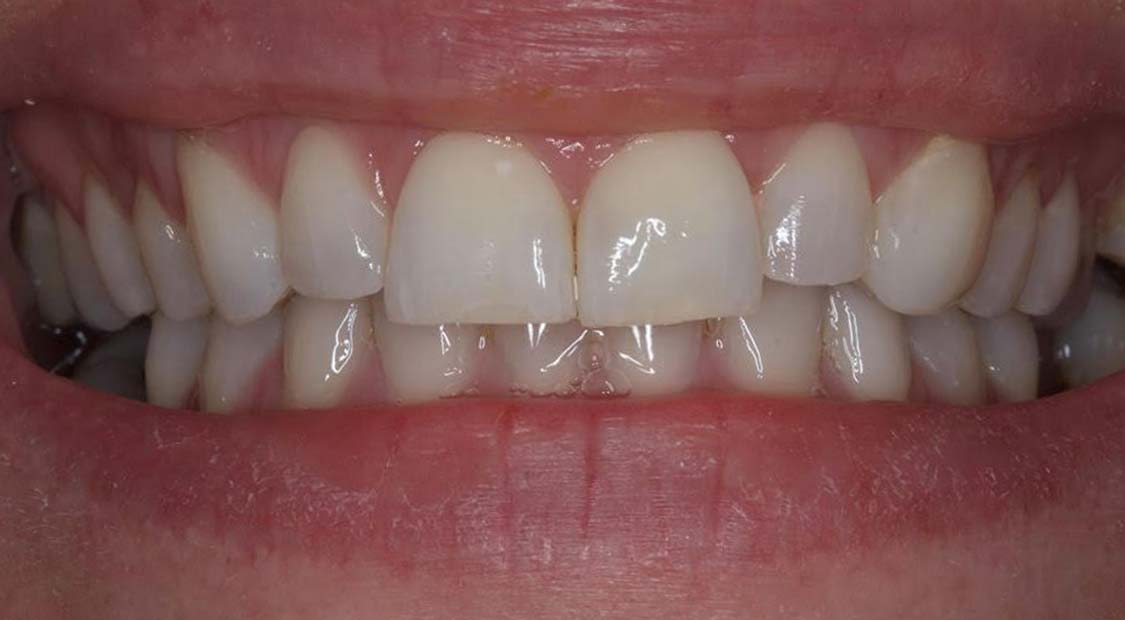 Braces then whitening – after