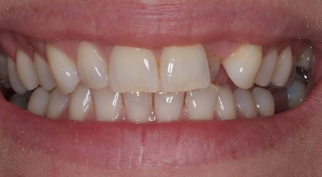 Braces then whitening – before