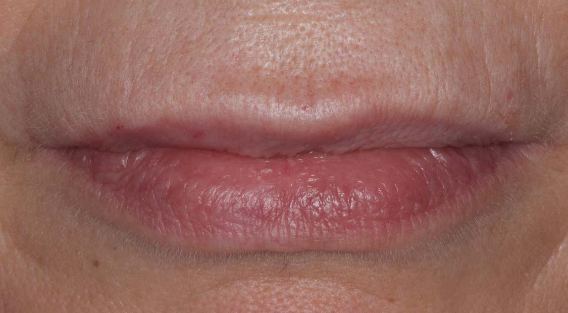 Lip filler – after