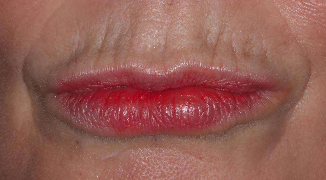 Lip filler – before