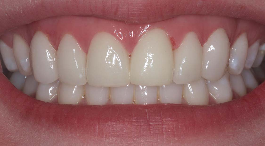 6 veneers to close spaces – after