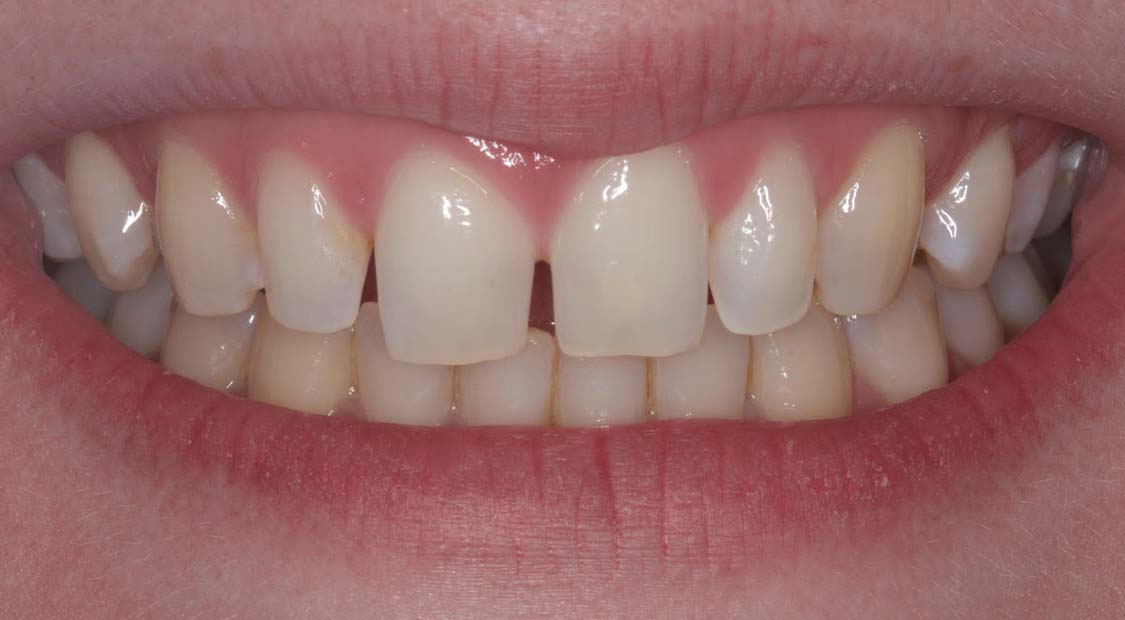 6 veneers to close spaces – before